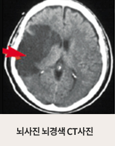 뇌경색 CT사진