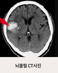 뇌출혈 CT사진