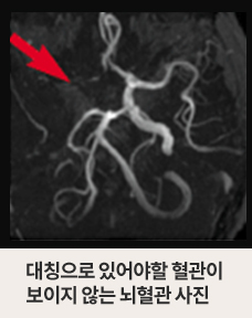 대칭으로 있어야할 혈관이 보이지 않는 뇌혈관 사진