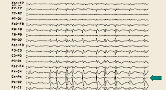 뇌파검사에서 기록된 간질파(화살표부분)
